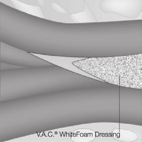 TEKNIKKER TIL TUNNELERING OG SINUSKANALER V.A.C. WhiteFoam Forbinding anbefales til brug i tunneler. Klip altid V.A.C. WhiteFoam Forbindingen bredere i den ene ende og smallere i den anden.