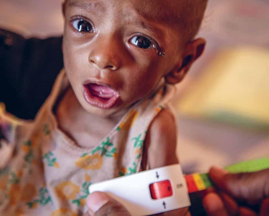 HVOR MANGE BØRN KAN VI NÅ AT REDDE Jonathan Hyams/Red Barnet Nabil bor i Yemen. Han er 11 måneder gammel men vejer kun 4 kilo halvdelen af, hvad han burde.