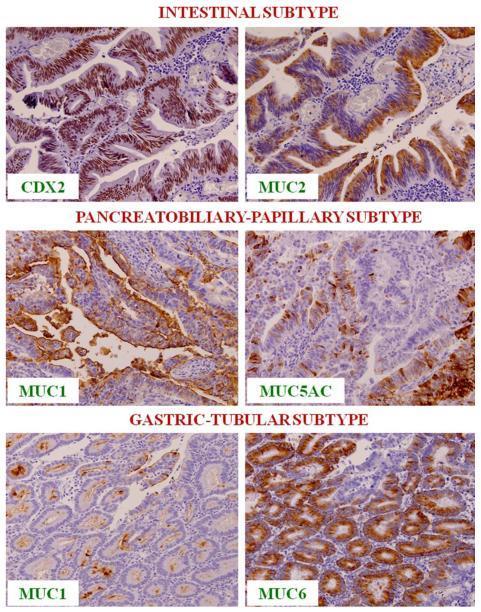 Intestinal versus pancreatobiliær neoplasi CK7 CK20 CDX2 MUC5AC MUC2 MUC1 (EMA) Intestinal type Pancreatobiliær type -/+ + + -/+ + - + -/+ (-) +/- - + Figur til højre: Nobuyuki O et
