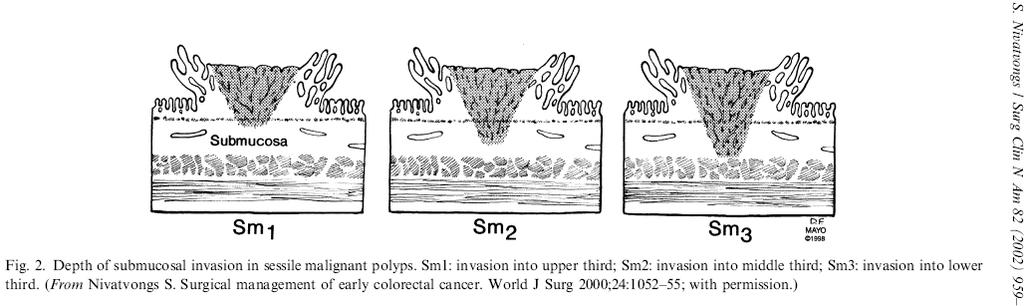 pt1 Kikuchi Sm-klassifikation (Kikuchi) (Nivatvongs 2002) Sessil/ fladeformet polyp pt1(sm1), øvre 1/3 af submucosa pt1(sm2),