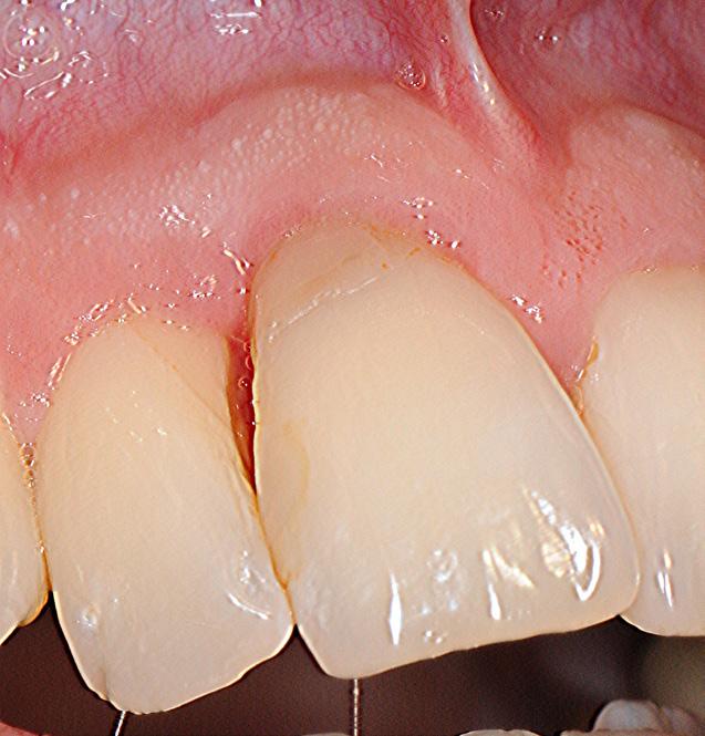 parodontalligamentet (6-8). Behandlingen burde i udgangspunktet have været afbrydning af den ortodontiske behandling hurtigst muligt og ikke endodontisk behandling.