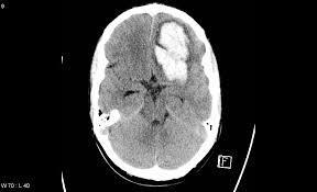 Hjernen Symptomer: Kortvarige halvsidige lammelser af ekstremiteterne (minutter) (TCI ) Blodprop i hjernen (apoplexia cerebri) Kortvarige anfald af blindhed på det ene øje (amaurosis fugax).