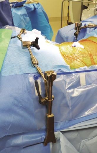 Step 1: Attach Rail Clamps Place Elite Rail Clamp with Extension Arm onto the rail over the sterile drape near the axilla of the patient, adjacent to armboard, and turn top knob