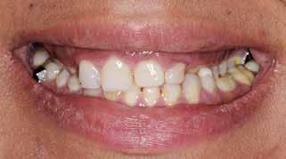 følsomheden af de enkelte tænder. Hypersensitiviteten kan også resultere i dårlig oral hygiejne med forøget risiko for caries og gingivitis.