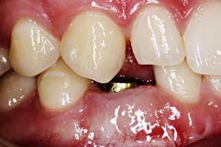 Kasus med hypodonti Selvom kompleksiteten i behandlingerne hyppigt stiger med antallet af manglende tænder, kan man godt være i tvivl om, hvilke materialer der bør anvendes i en kasus, hvor kun en