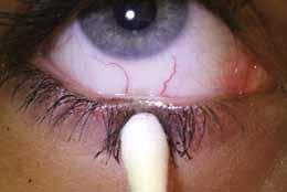 Advanced methods to diagnose and monitor Tear film osmolarity Failure of homeostatic tear osmolarity is linked with DED and the osmolarity analysis is regarded by some as the gold standard in DED