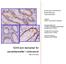 SOX9 som biomarkør for cancerstamceller i coloncancer. ROSKILDE UNIVERSITET Medicinalbiologi, Fagmodulprojekt. Vejleder: Maiken Lise Marcker Espersen