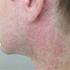 Kronisk urticaria. Dermatologi