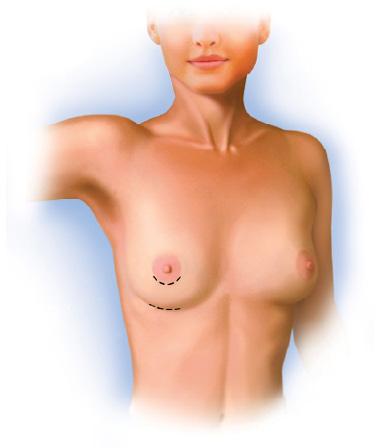 Forventninger En fjernelse af implantatet vil medføre et mere slapt bryst. Jo større bryst implantatet er, jo mere slapt og rynket vil brystet blive efterfølgende.