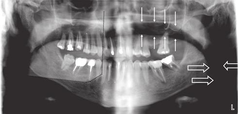 Panoramarøntgen Underkæbevisdomstænder fremviser ofte manglende eller kun delvist frembrud i mundhulen grundet pladsmangel.