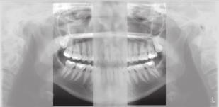 Panoramarøntgen kontrol af implantaters osseointegration er panoramaoptagelse ikke velegnet grundet teknikkens mangel på fuldkommen ortoradialitet.