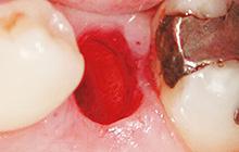 patienter, atraumatisk og uden ubehag. Benex II system giver dig garanti for skånsom ekstraktion af tænder og rødder i hele mundhulen, let og ubesværet.