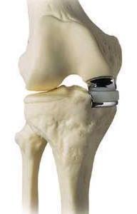 I nogle tilfælde er det kun den indvendige del af knæleddet, der er slidt. I det tilfælde kan der indsættes en delprotese.