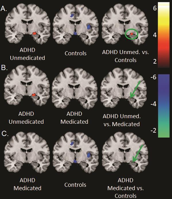 Øget amygdala-aktivitet i ADHD: Normalisering med methylphenidat Posner