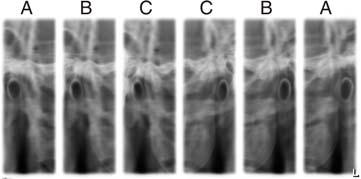 gennemstrålingsområdet posterior - anterior i 2-dobbelt visning på et billede. 5.5.1.