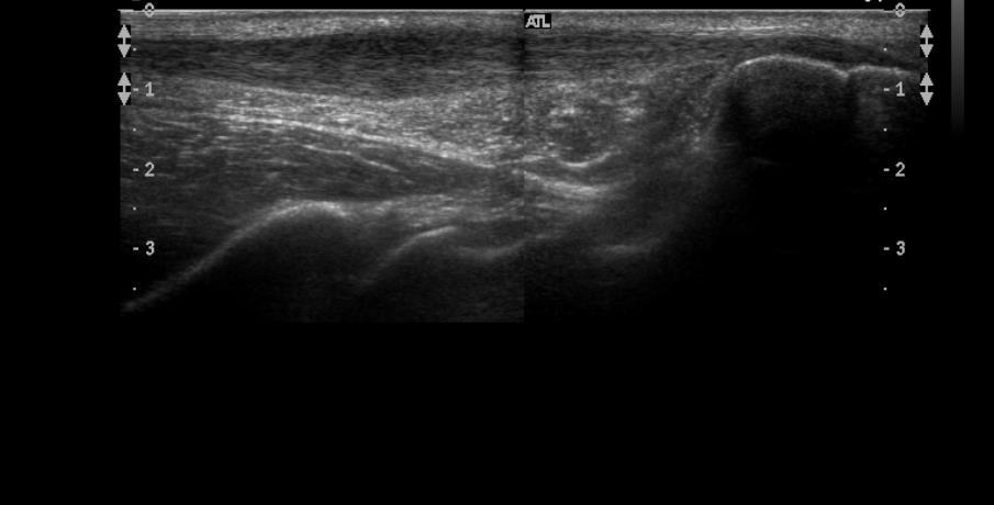 Bemærk: Achillessenen er syg (fortykket) nogle cm proximalt for tuber Achilles sene Dybe flexorer Tibia Kagers fedtpude
