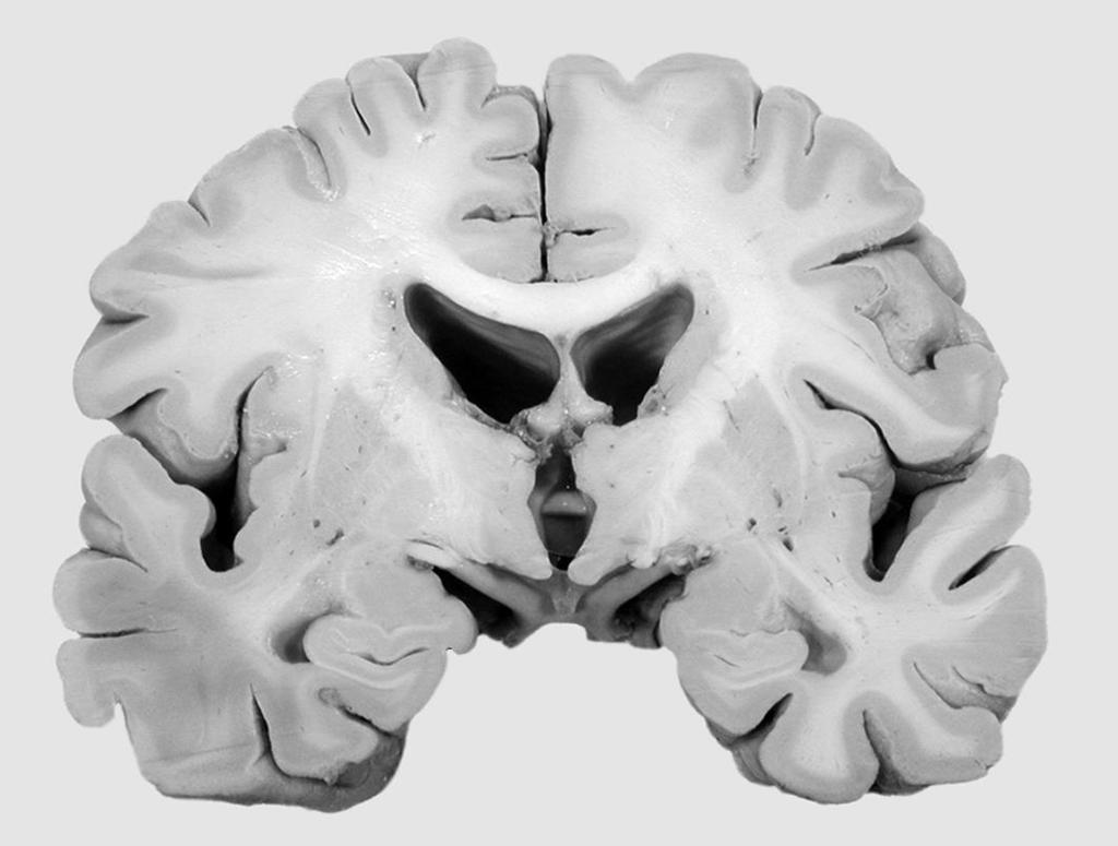 Storhjernen (cerebrum) Udgøres af en række indre kernestrukturer: hypofyse,