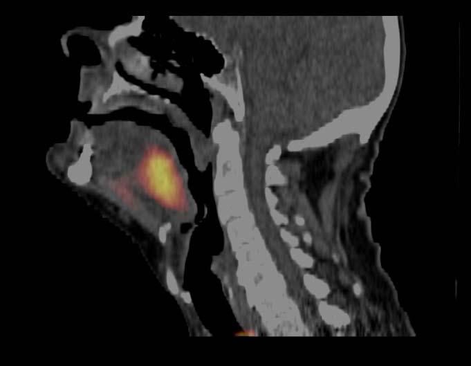 Eksempel: Biologisk baseret udvikling af strålebehandling af hoved-hals kræft Loco-regional control (%) 100 80 60 40 20 DAHANCA Database Stage 3-4 Larynx and Pharynx 83% 62% 44% 27% Øget