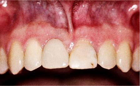 Tandunderstøttet brobehandling til patienter med omfattende tandtab.  Bahrami Møller, Golnoush; Øzhayat, Esben Boeskov; Klausen, Bjarne - PDF  Free Download