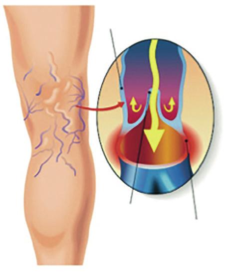 Information om åreknuder Åreknuder er udvidede og slyngede blodårer (vener) på benene, der ligger lige under huden. Den mest almindelige årsag til åreknuder er slidte eller defekte veneklapper.