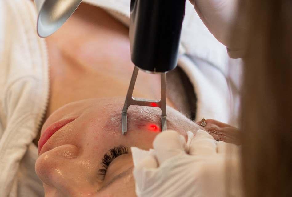 Laserbehandling af akne og rosacea Om behandlingen Akne og rosacea er kroniske hudsygdomme som rammer en stor del af befolkningen.