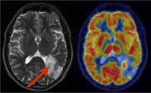På de næste to billeder kan man se først en MR scanning, som viser en afvigelse (det kan være resultatet af en hjerneblødning eller andet) og på billede nr.
