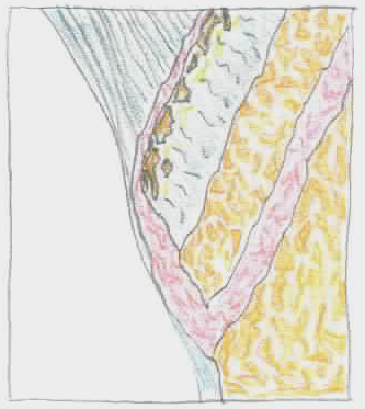 Apofysitis illustration af principper knoglefragmenter separation fyldt med fibrøst væv vækstzone