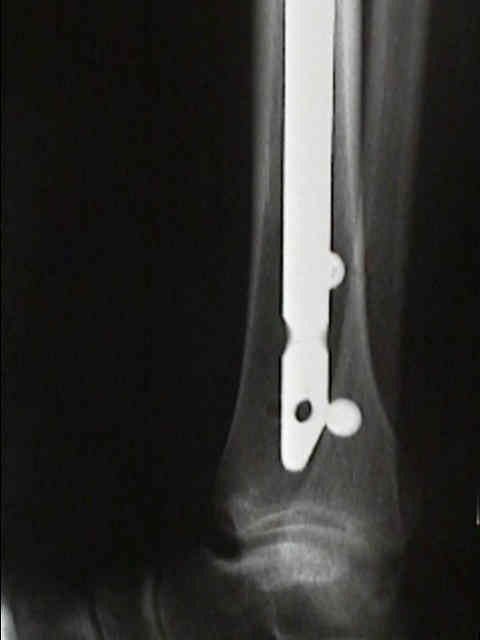 The purpose of this study was to assess the union of distal third tibial fractures in patients who have undergone intra-medullary (IM) tibial nailing with one versus two distal locking screws.