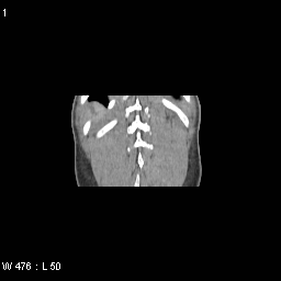 Systematisk gennemgang CT af abdomen ved akutte abdominale smerter Ofte samtidig ca 100