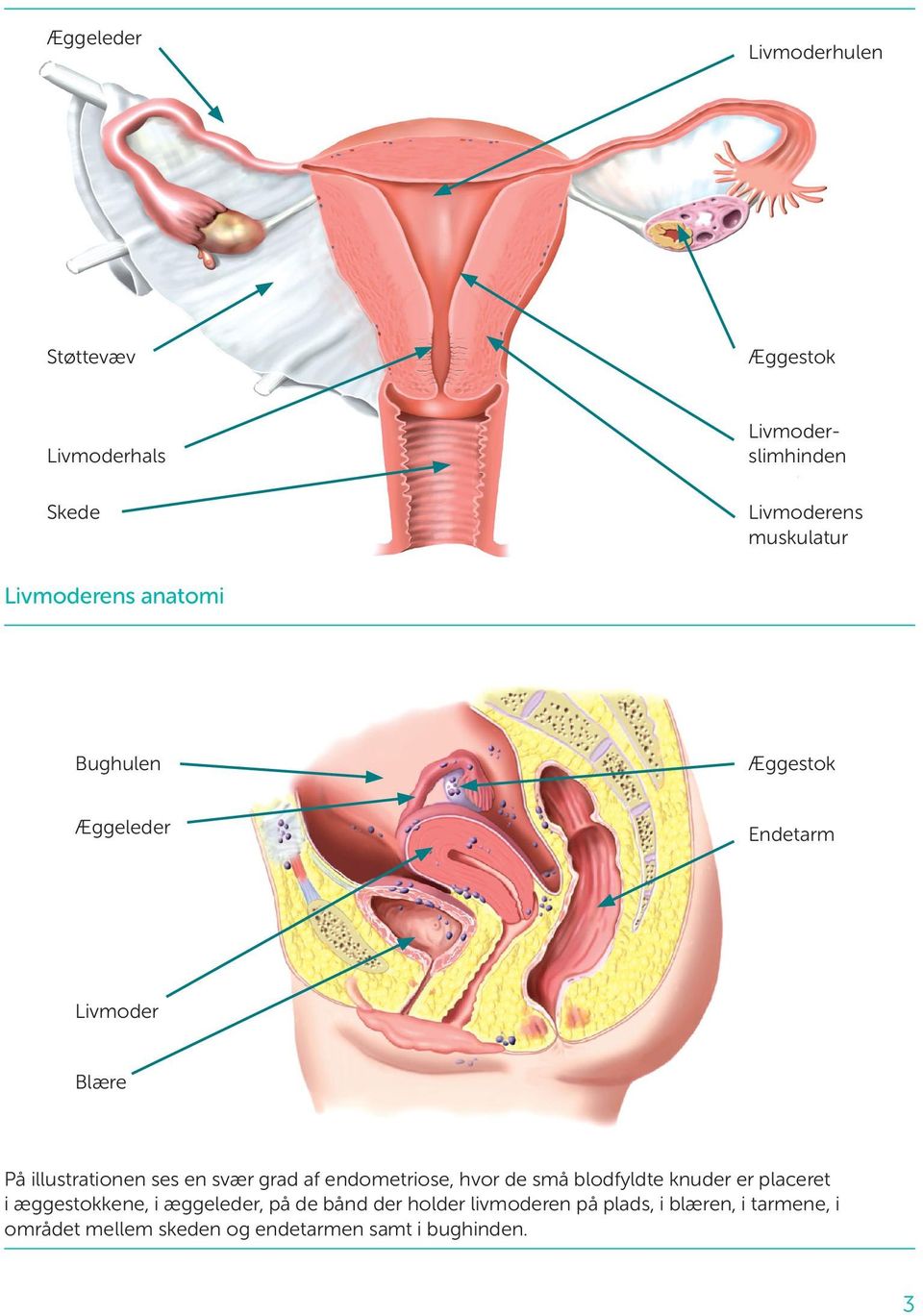 grad af endometriose, hvor de små blodfyldte knuder er placeret i ægge stokkene, i æggeleder, på de bånd