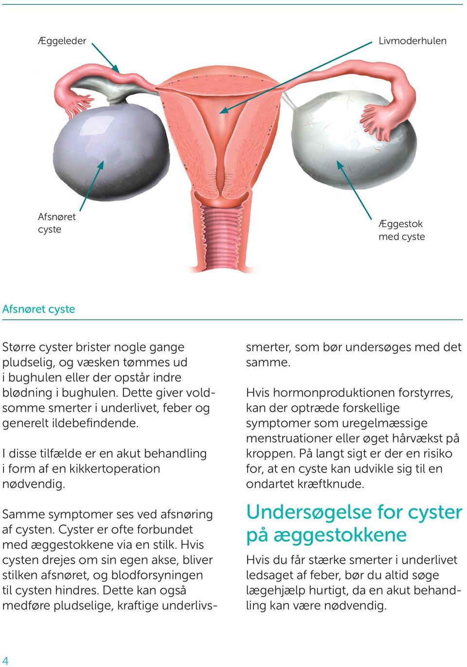 Samme symptomer ses ved afsnøring af cysten. Cyster er ofte forbundet med ægge stokkene via en stilk.