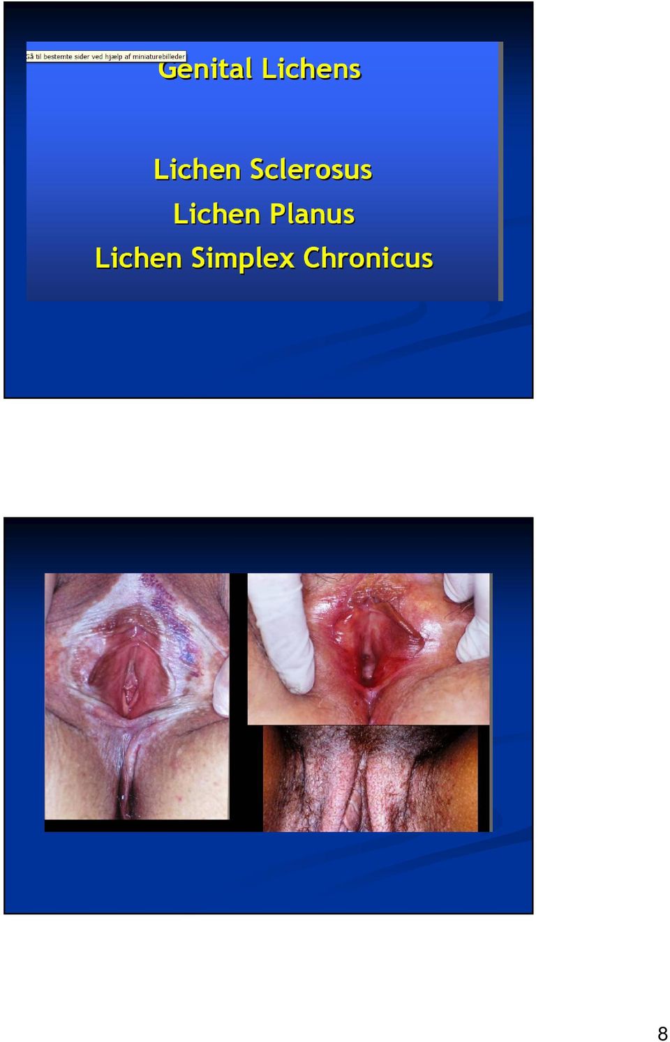 Benigne vulvalidelser - PDF Gratis download