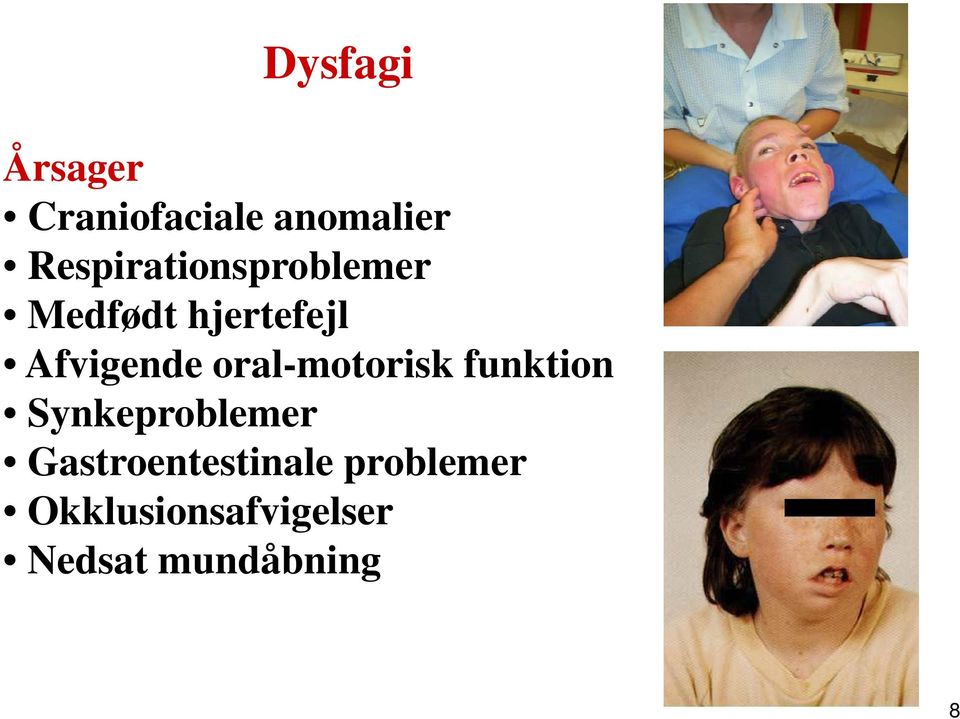 Afvigende oral-motorisk funktion Synkeproblemer