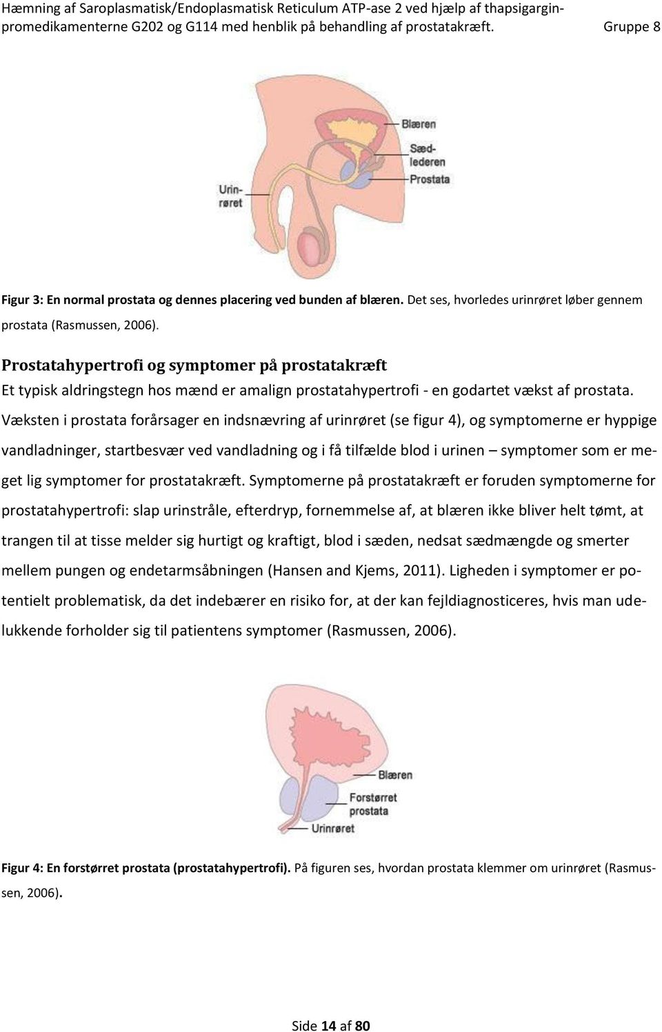 Væksten i prostata forårsager en indsnævring af urinrøret (se figur 4), og symptomerne er hyppige vandladninger, startbesvær ved vandladning og i få tilfælde blod i urinen symptomer som er meget lig
