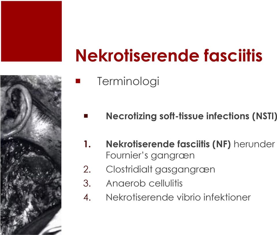 Nekrotiserende fasciitis (NF) herunder Fournier s