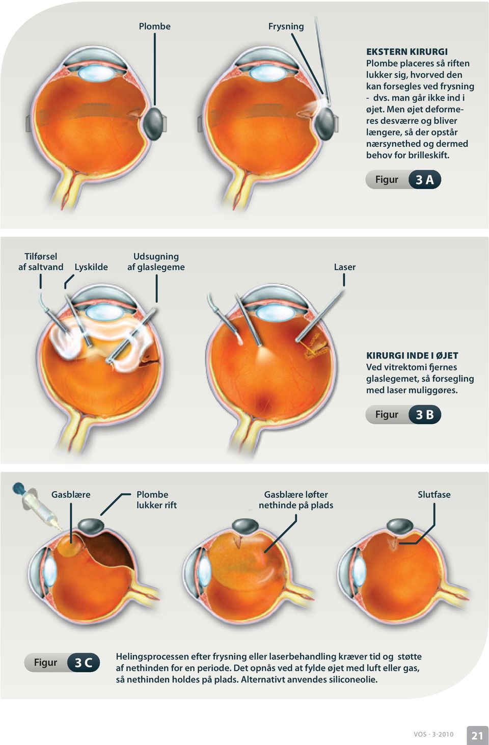 3 a Tilførsel af saltvand Lyskilde Udsugning af glaslegeme Laser Kirurgi inde i øjet Ved vitrektomi fjernes glaslegemet, så forsegling med laser muliggøres.