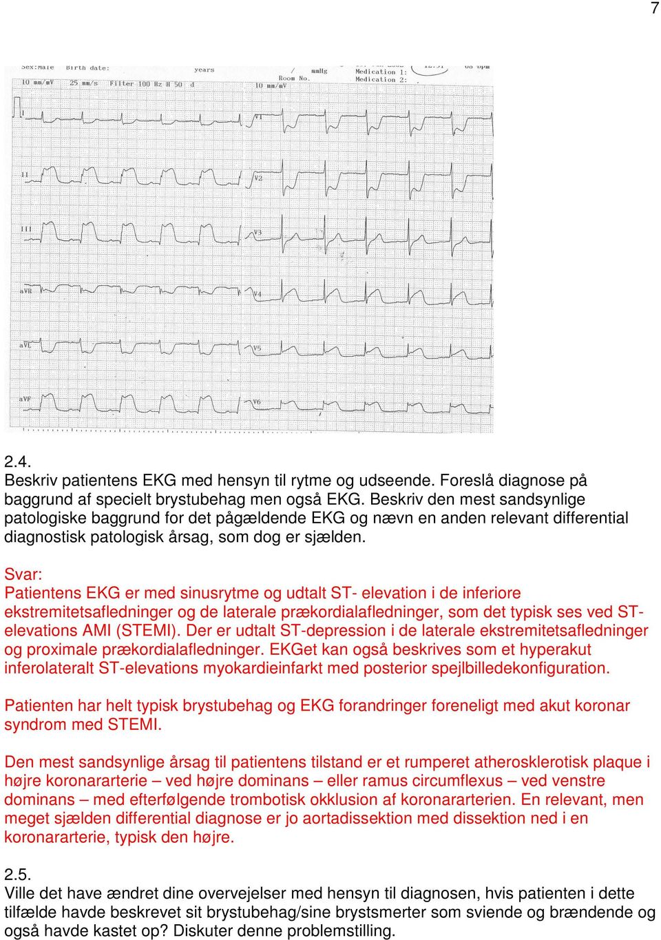 Patientens EKG er med sinusrytme og udtalt ST- elevation i de inferiore ekstremitetsafledninger og de laterale prækordialafledninger, som det typisk ses ved STelevations AMI (STEMI).