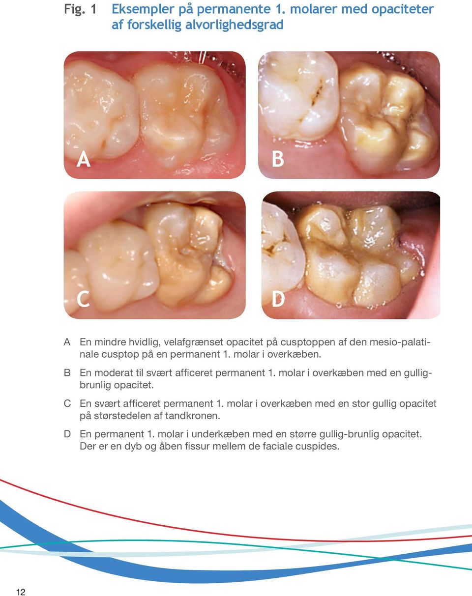 mesio-palatinale cusptop på en permanent 1. molar i overkæben. B En moderat til svært afficeret permanent 1.