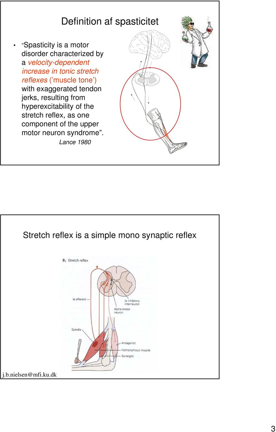 tendon jerks, resulting from hyperexcitability of the stretch reflex, as one component of