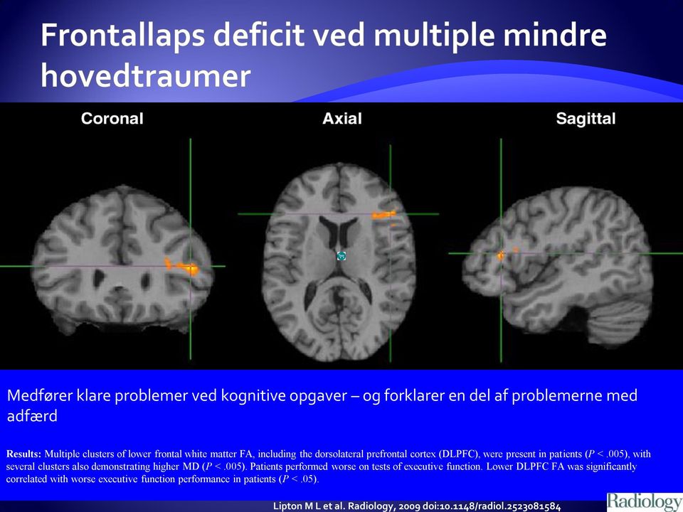 lower frontal white matter FA, including the dorsolateral prefrontal cortex (DLPFC), were present in patients (P <.