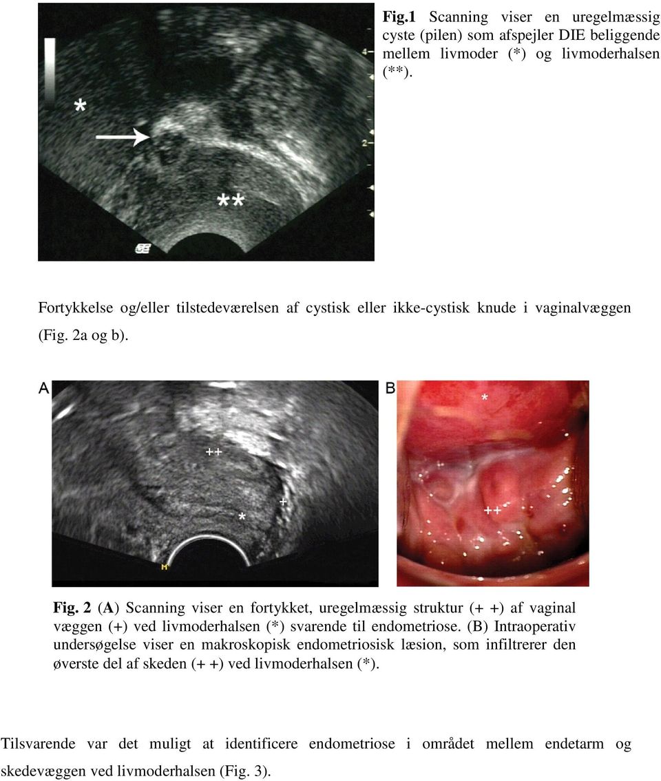 2 (A) Scanning viser en fortykket, uregelmæssig struktur (+ +) af vaginal væggen (+) ved livmoderhalsen (*) svarende til endometriose.