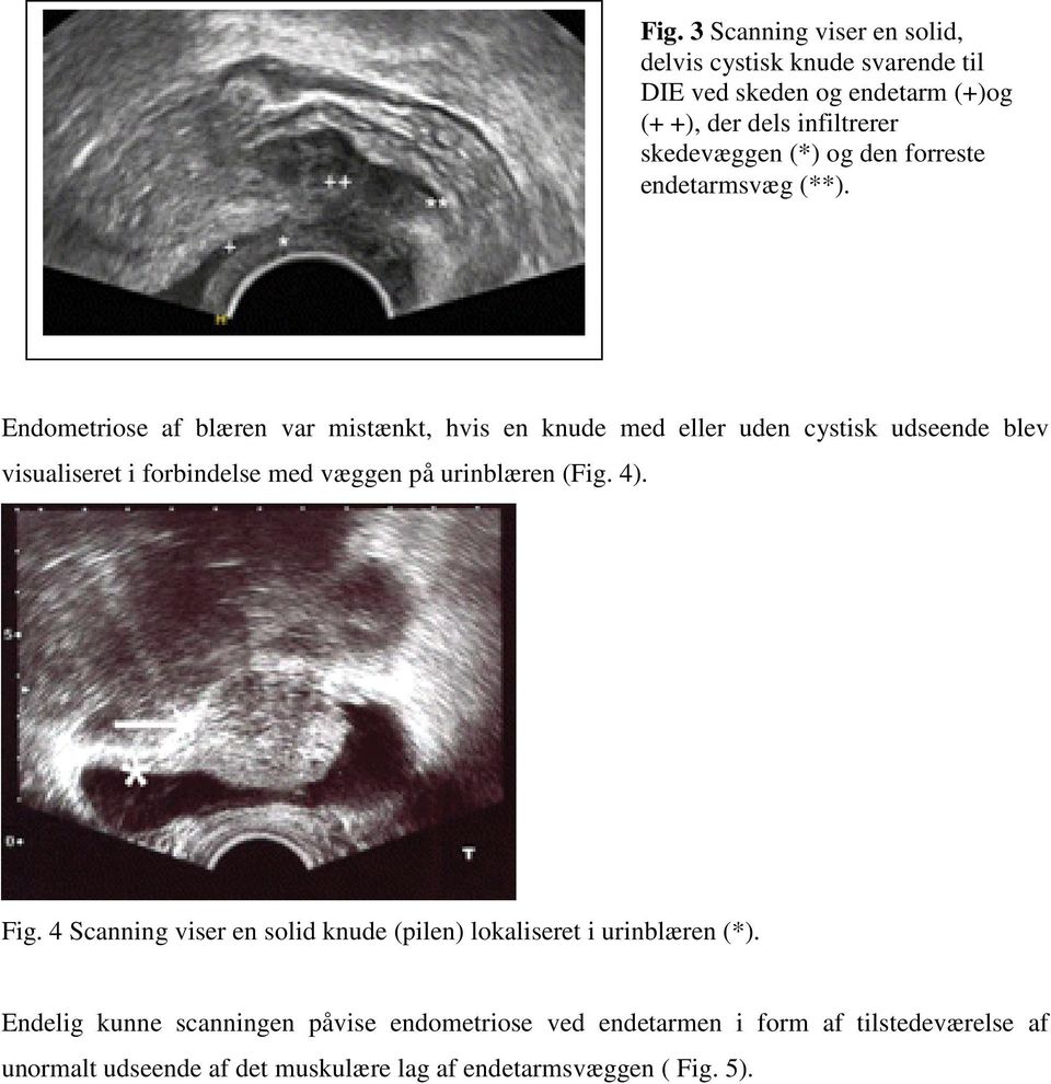 Endometriose af blæren var mistænkt, hvis en knude med eller uden cystisk udseende blev visualiseret i forbindelse med væggen på urinblæren