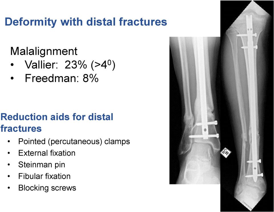 for distal fractures Pointed (percutaneous) clamps