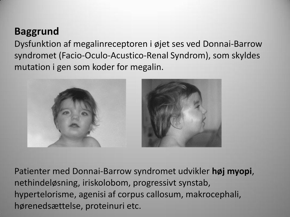 Patienter med Donnai-Barrow syndromet udvikler høj myopi, nethindeløsning, iriskolobom,
