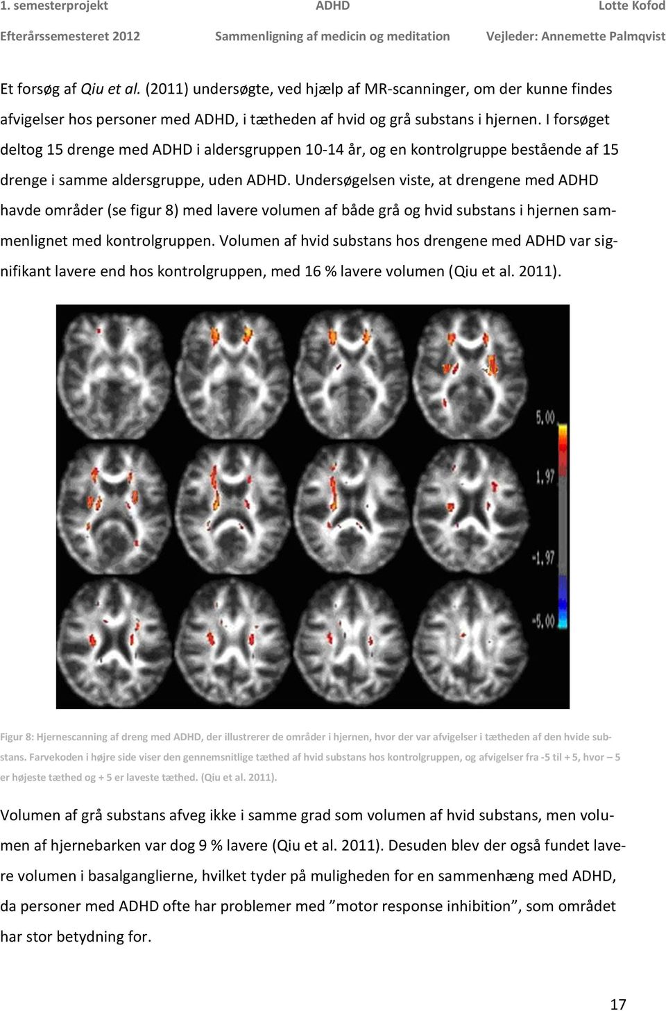 Undersøgelsen viste, at drengene med ADHD havde områder (se figur 8) med lavere volumen af både grå og hvid substans i hjernen sammenlignet med kontrolgruppen.