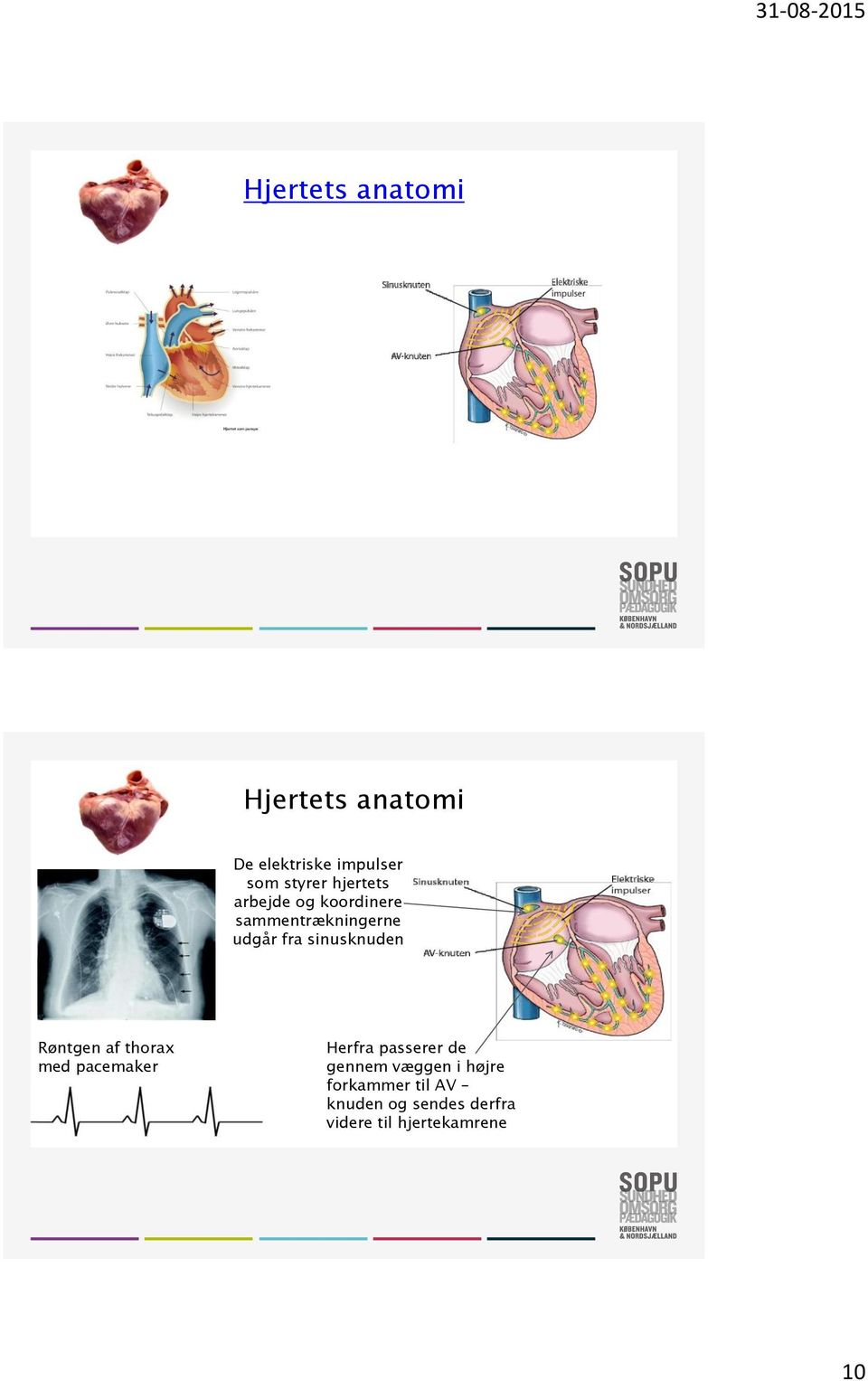 sinusknuden Røntgen af thorax med pacemaker Herfra passerer de gennem
