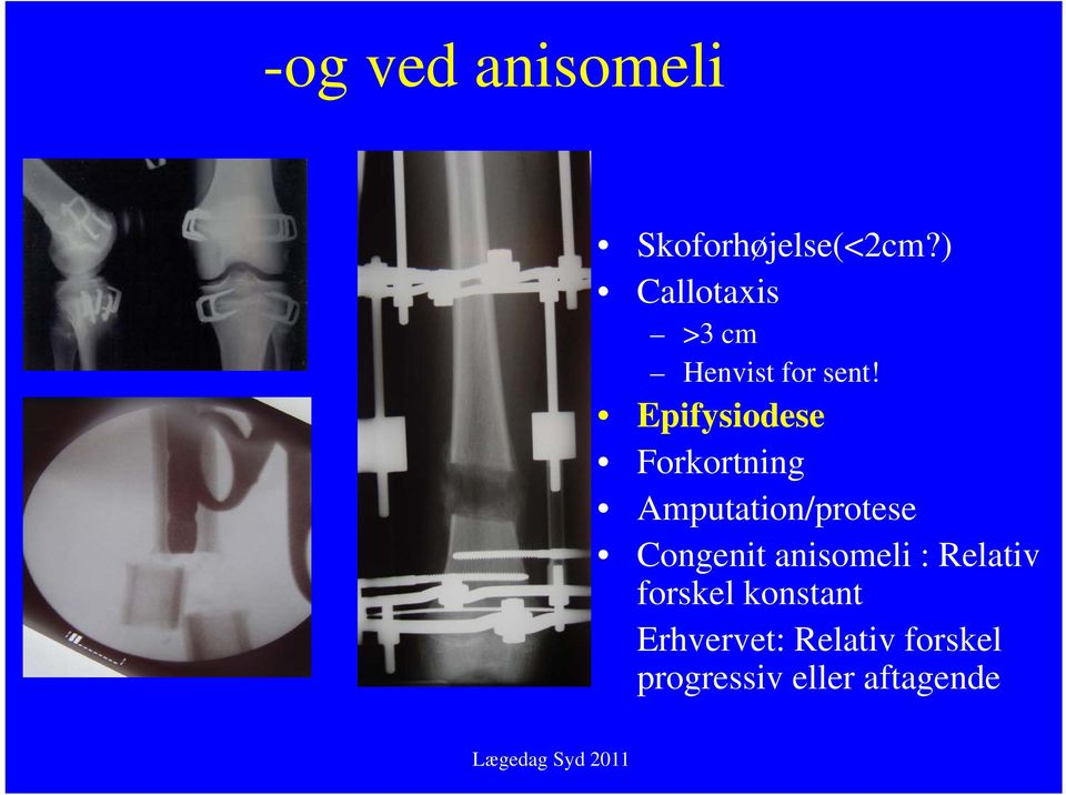 Epifysiodese Forkortning Amputation/protese Congenit