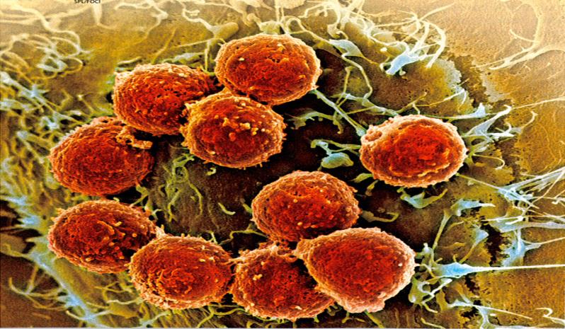 Videnskabelig baggrund Proof-of-Principle i humane cancerceller RhoC-specifikke dræberceller eliminerer cancerceller.