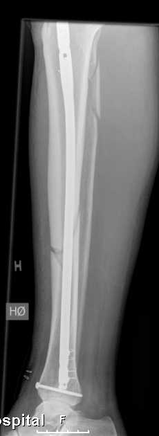 Using absolute stability in the intraarticular fracture Using relative stability in