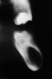A B C D Fig. 1. Eksempler på komplicerende fund ved tomografisk røntgenundersøgelse mhp. implantatbehandling. A: Utilstrækkelig højde af processus alveolaris i regio +5.